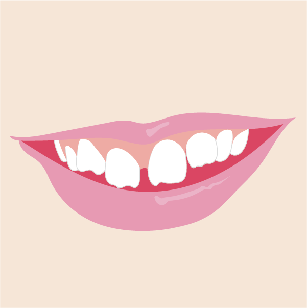すきっ歯のイメージ画像