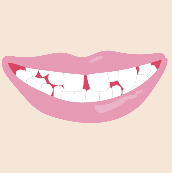 八重歯のイメージ画像