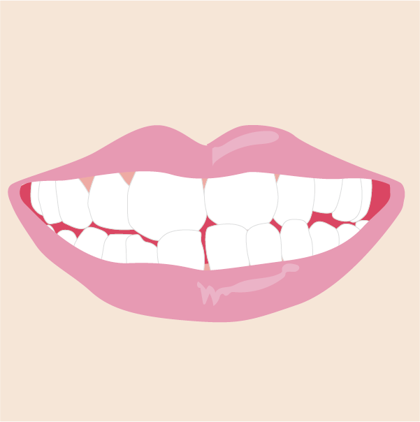 噛み合わせが悪いのイメージ画像