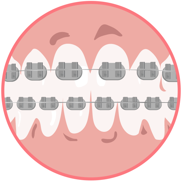 ワイヤー矯正のイメージ画像