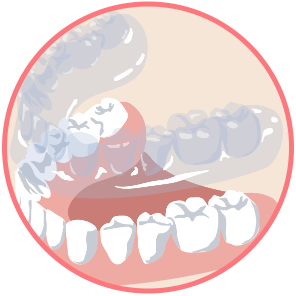 マウスピース矯正のイメージ画像