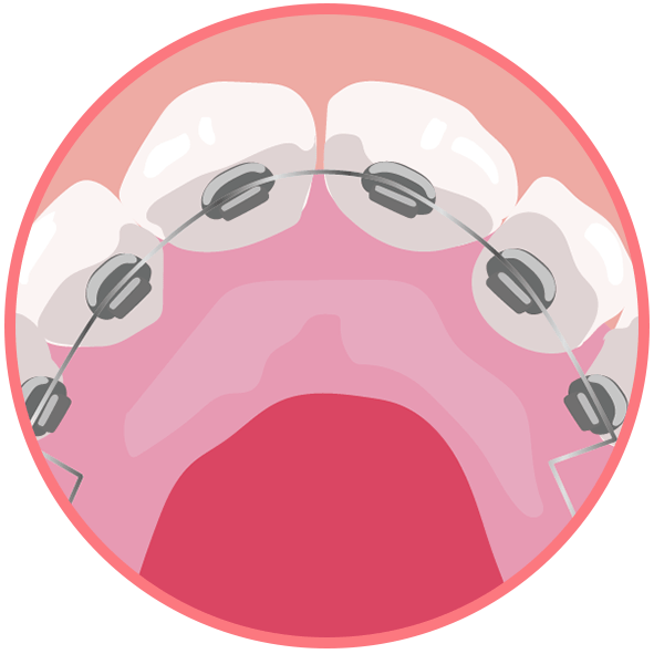 裏側矯正のイメージ画像