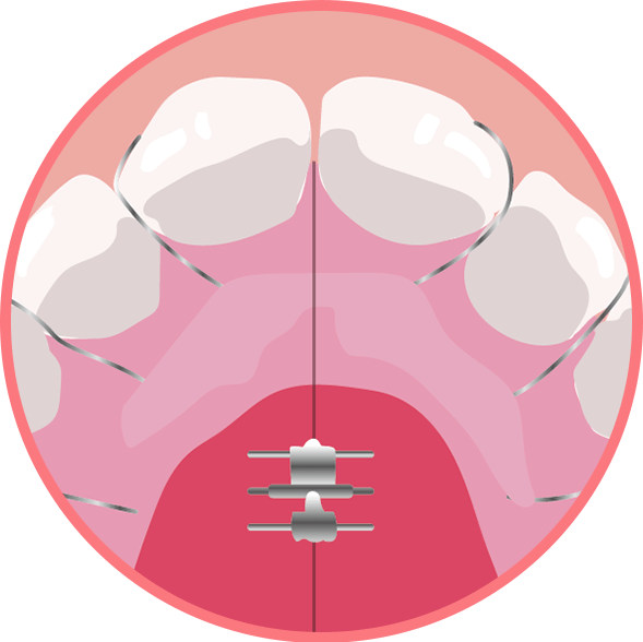 拡大床矯正のイメージ画像