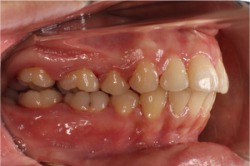 出っ歯の症例_after