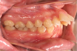 出っ歯の症例_before