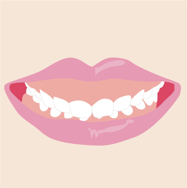 ガミースマイルのイメージ画像