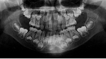 レントゲンで撮影した歯の生え変わりの様子