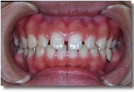 すきっ歯_before
